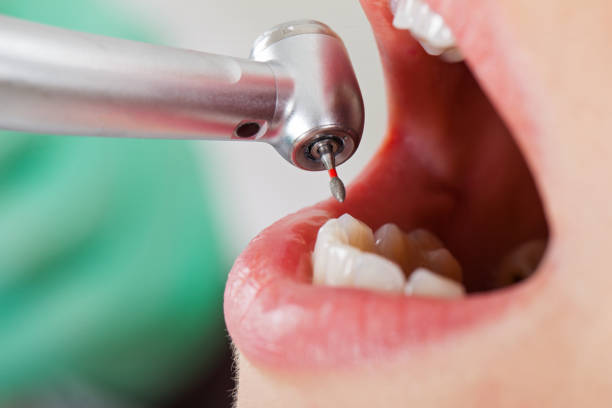 Best Emergency Wisdom Tooth Extraction in Ocean Park, WA